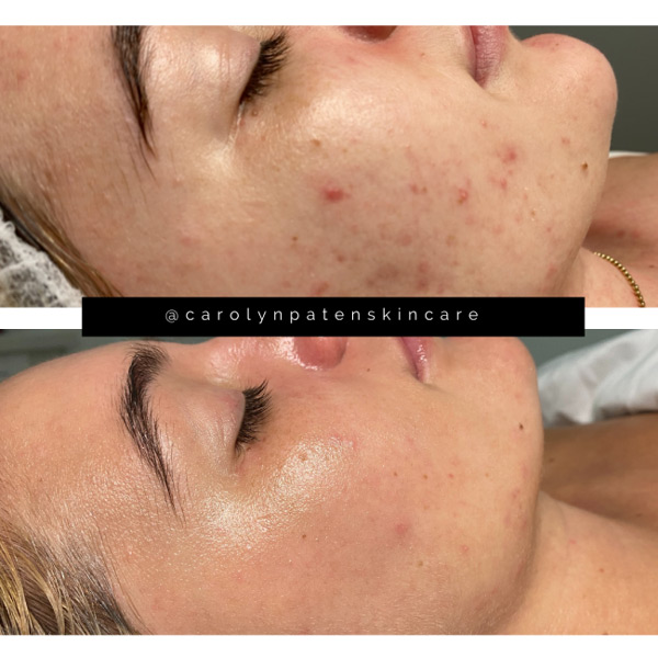 Facial before & after