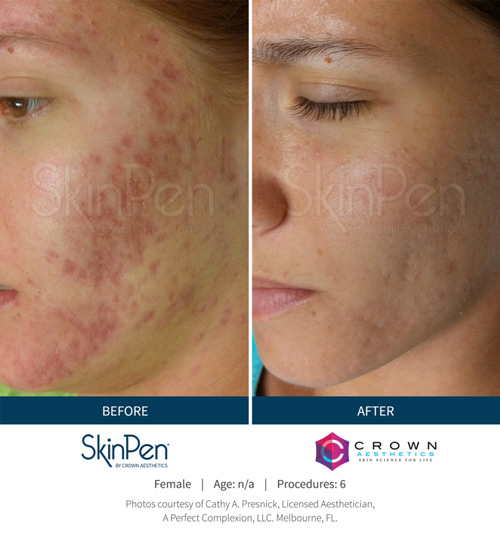 Skin Pen b&a 1