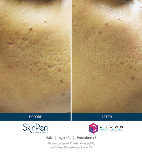 Skin Pen b&a 3