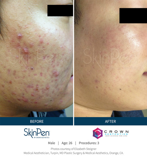 Skin Pen b&a 2
