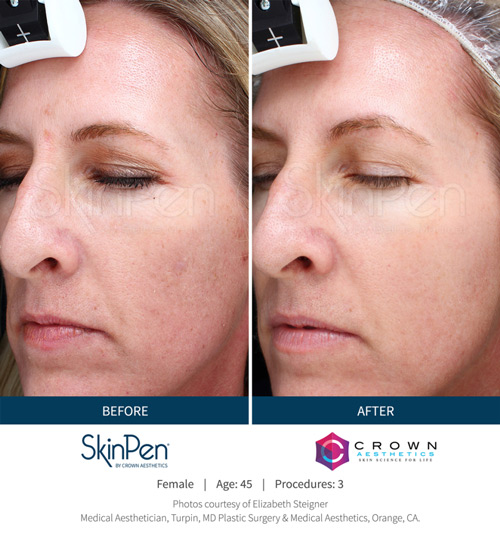 Skin Pen b&a 7