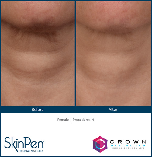 Skin Pen b&a 4