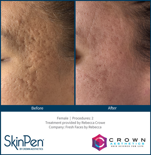 Skin Pen b&a 8
