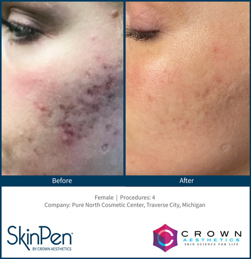 Skin Pen b&a 6